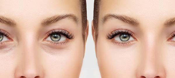 Blepharoplasty in Delhi