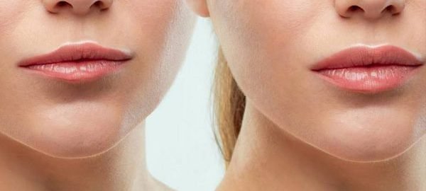 Lip-Reshaping in Delhi