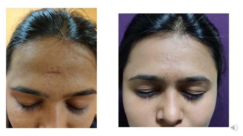 scar revision surgery in Karnal