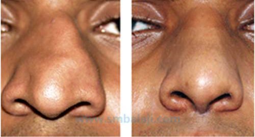 Nose-reshaping