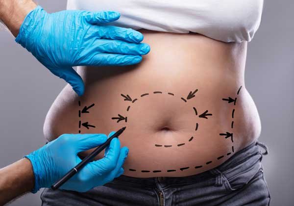 Abdominoplasty Abdominoplasty in noida