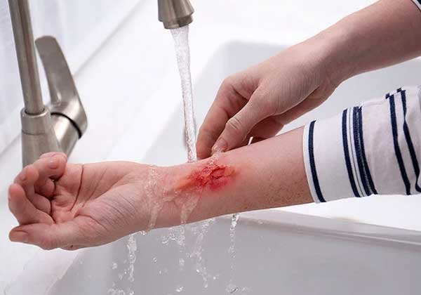 Burn-Treatment burn treatment in noida