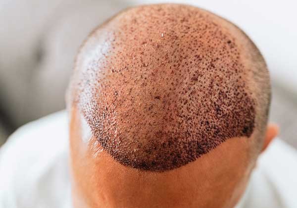 Hair-Transplant hair transplant in Noida