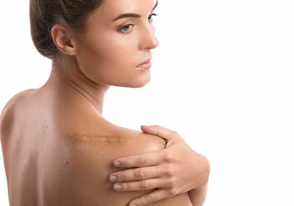 Scar-Revision scar revision in noida